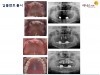 임플란트 틀니 사례