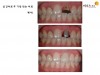 부러져 뿌리만 남은 앞니 치료